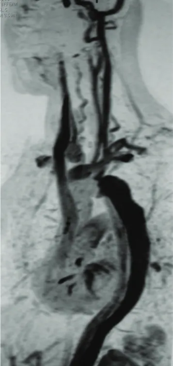 Figura 4 - Angiotomografia computadorizada: aneurisma da