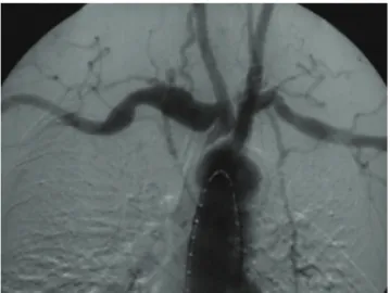 Figura 5 - Angiografia digital (pré-operatório)