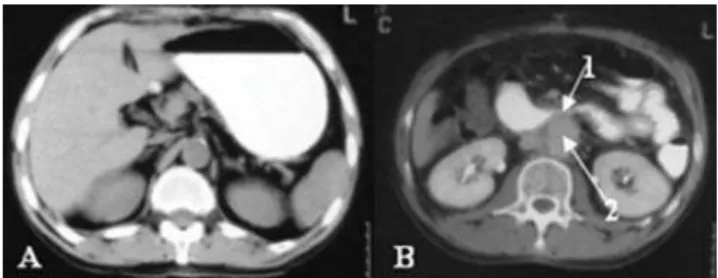 Figura 1 - A) Visão panorâmica da aortografia; B) detalhe da
