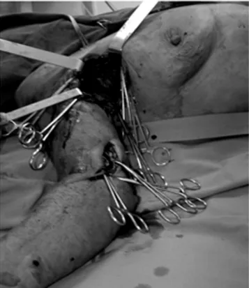 Figura 1 - Arteriografia pré-operatória demonstrando extra-