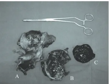 Figura 3 - Trombo “organizado” (A e B); hematoma lique-