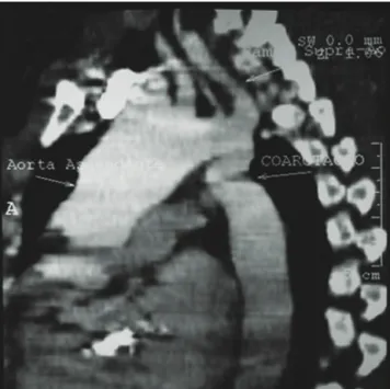 Figura 1 - Angiotomografia computadorizada demons- demons-trando coarctação da aorta em nível de aorta  torá-cica, porção descendente alta