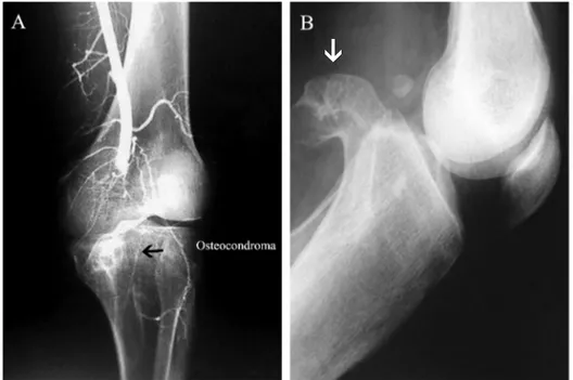 Figura 1 - A) Angiografia: osteocondroma com oclusão arterial proximal (seta); B) RaioX de perfil do osteocondroma tibial (seta)