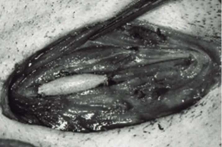 Figura 3 - Aspecto do implante da prótese de tecido e látex