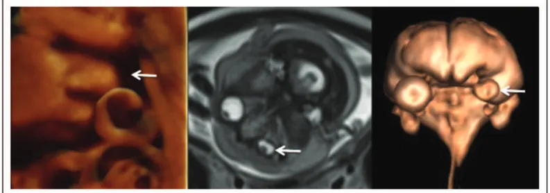 FIGURE 2. Three-dimensional virtual reconstruction from computed tomography of the neonate showing microcephaly.