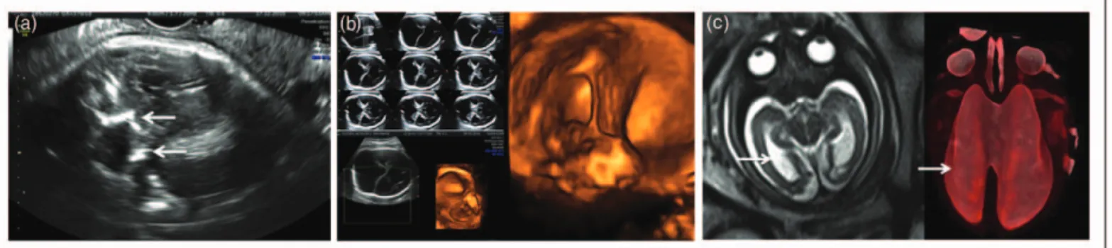 FIGURE 3. (a) Transvaginal ultrasound shows brain calcifications (arrows) and microcephaly in a 37-week fetus