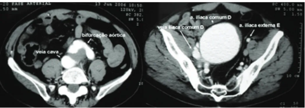 Figura 2 - A) aneurisma da artéria ilíaca comum direita; B) correção com prótese bifur-