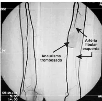 Figura 2  - Imagem compatível com aneurisma trom- trom-bosado na artéria fibular esquerda,  arterio-grafia realizada no primeiro internamento