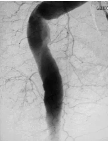 Figura 2 - Angiografia com subtração digital seletiva da artéria isquiática interna