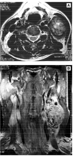 Figura 2 - A ) Estudo angiográfico evidenciando grande neoformação vascular, que nutre massa  tumo-ral ao nível cervical; B) aspecto angiográfico após realizar embolização intra-arterial, com micropartículas esféricas