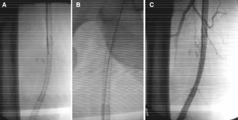 Figura 3  - A ) Angiotomografia pré-operatória; B) controle pós-recanalização da artéria femoral superficial direita; C) controle após recanalização da artéria femoral superficial esquerda (notar em B e C os ramos originados no território recanalizado)