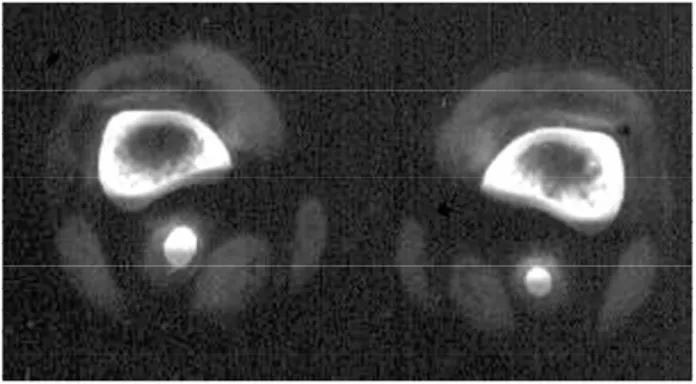 Figura 1 - Corte transversal de tomografia computadori- computadori-zada no nível do 1/3 distal do fêmur (caso 1): aneurisma de artéria poplítea bilateral