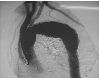 Figura 5   - Conjunto dos stents retirados do trajeto fistular da aorta para o esôfago