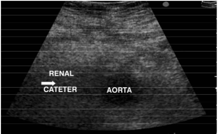 Figura 2 - Cateterismo da artéria renal direita confirmada pelo eco-Doppler colorido