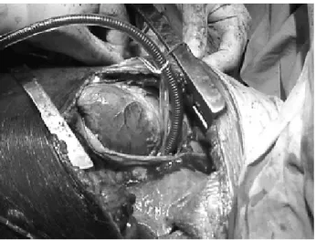 Figura 7 - Caso 3: aspecto após o implante da prótese de Dacron
