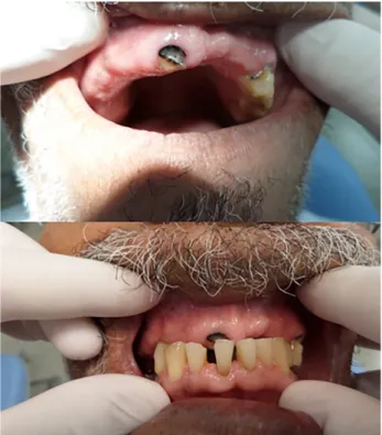 Figure 2 - Clinical conditions of oral health in a leprosy case :  periodontitis, absence of dental elements, dental caries