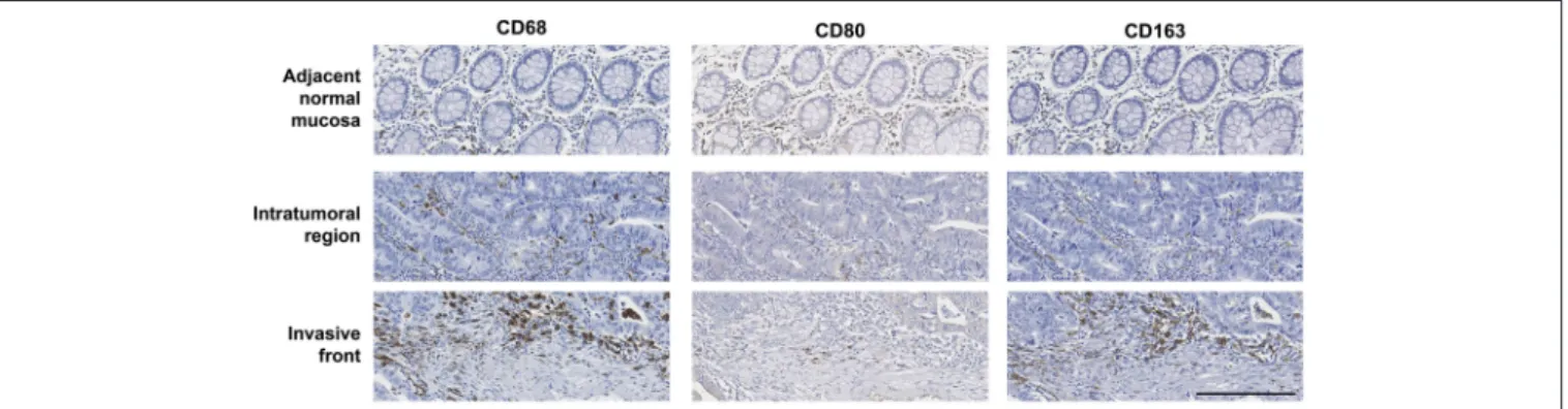 FIGURE 1 | Immunostaining of CD68, CD80, and CD163 in the tumor adjacent normal mucosa, intratumoral region and invasive front of a representative colorectal cancer case, in consecutive paraffin-embedded sections