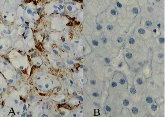 Figura 1 – Imuno-histoquímica da expressão da actina-de músculo liso (anti-músculo  liso) na biópsia hepática inicial antes do tratamento (A) e após remissão clínica (B)  (aumentoX400)