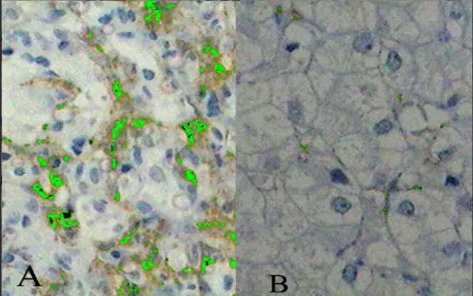 Figura  2  -  Imuno-histoquímica  (em  verde)  demonstrando  forte  expressão  de  actina  de  músculo  liso  na  biópsia  hepática  inicial  antes  do  tratamento  (A)  e  sua  quase  ausência na biópsia hepática após a remissão  clínica (B) (aumento X400
