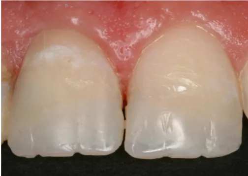 Figura  7 - Fotografia Frontal Final das Peças Dentárias 