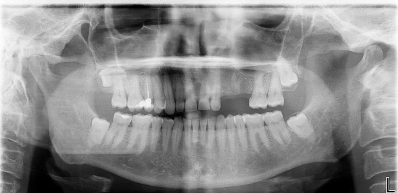 Fig. 10- Radiografia panorâmica 2011 