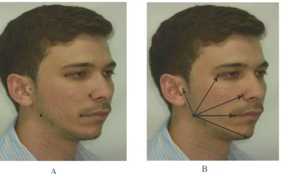 Figura 1- A -Vista lateral da face com a marcação dos pontos craniométricos. B-  Vista lateral da face demonstrando como foi feita a medida linear