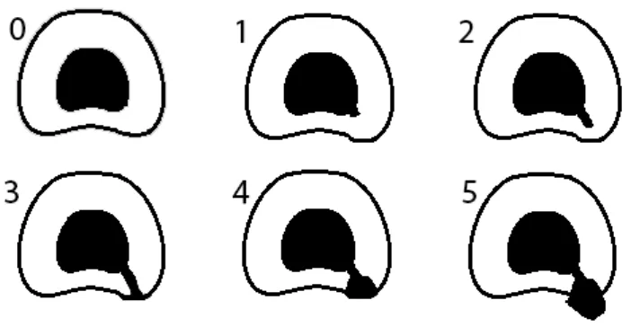 Figure  3.2.  Classification  of  annular  tears  first  purposed  by  Sach  et  al.  in  1990,  which  has  been  modified by Bogduk et al