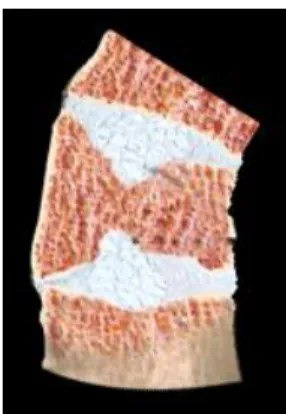 Figure 3.4. NP protrusions (Schmorl’s nodes) into the CEPs due to trabecular microdamage driven by  NP biochemical imbalance