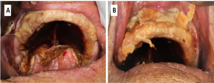 Figura  1.  a)  Lesão  em  palato  duro  com  extensão  em  palato  mole  e  coloração  amarelada  necrótica  e  escurecida;  b)  Lesão  amarelada  necrótica  em  rebordo  alveolar  e  fundo  de  sulco  anterior de maxila