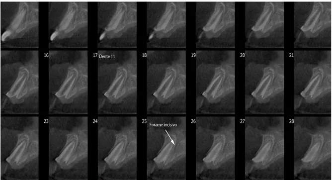 Figura 1  –  Tomografia computadorizada de feixe cônico do dente 11: a fratura se encontra no  nível da crista óssea palatina 