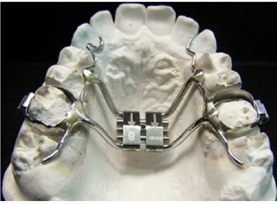 Figura 3 – Vista oclusal de um expansor maxilar rápido, adaptado de Guilleminault C,  Monteyrol P, Huynh N, Pirelli P, Quo S, Li K