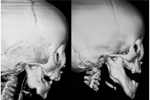Figura 6 – Tomografias computorizadas antes da DOM (imagem à esquerda)  e posterior à mesma (imagem à direita), adaptado de Miloro M