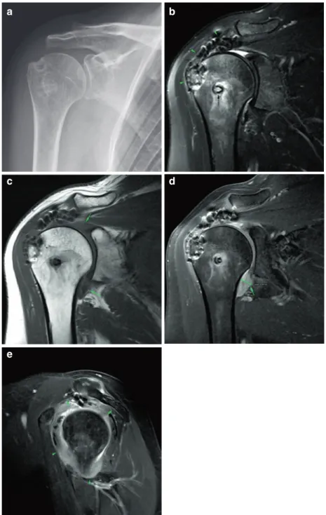 Fig. 8.7  (a–e) Cuff repair follow-up. Adhesive capsulitis. 