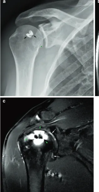 Fig.  8.1  (a–c)  Metal  susceptibility  artifact.  (a)  Frontal  radiograph of the shoulder