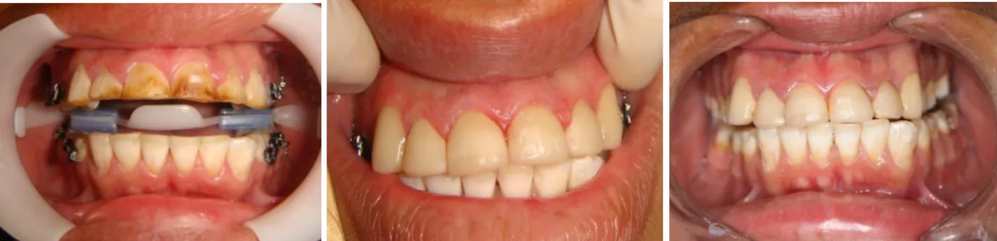 Figura  1.  Dentes  com  fluorose  grave,  tratados  com  facetas  estéticas  diretas  de  resina  (baseline, após o tratamento e follow-up) 