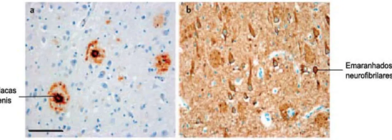Figura  1  –  Alterações  morfológicas  características  da  DA.  a)  Placas  senis  constituídas  por  depósitos  extracelulares  do  peptídio  beta-amiloide