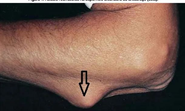 Figura 1. Nódulo reumatóide na superfície extensora do antebraço (seta). 