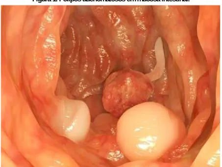 Figura 1. Pólipos adenomatosos em mucosa intestinal. 