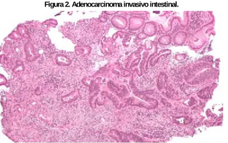 Figura 2. Adenocarcinoma invasivo intestinal. 
