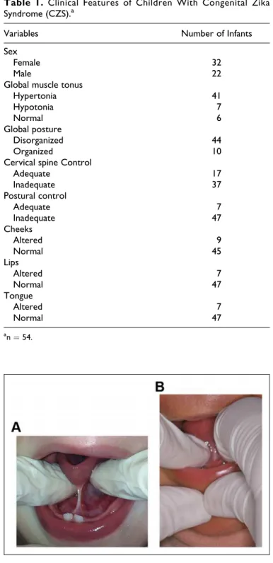 Figure 2. Most frequently observed lingual frenulum phenotypes in children with congenital Zika syndrome (CZS)