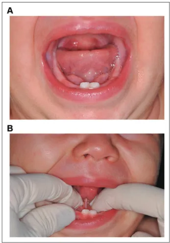 Table 2. Association Between the Presence of Dysphagia and Posteriorly Positioned Lingual Frenulum Among Children With Congenital Zika Syndrome (CZS)