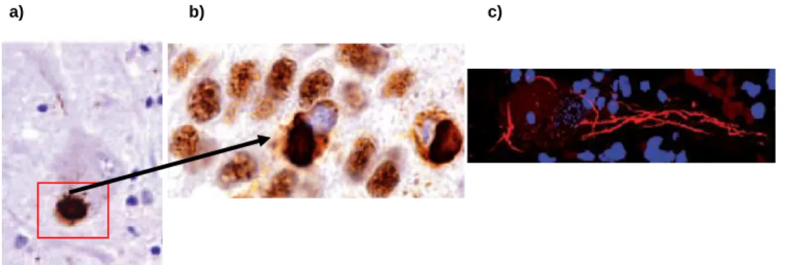 Figura  1.1  -  Estudo  da  mutação  de  TDP-43  na  ELA  por:  a)  imunohistoquímica;  b)  ampliação  da  Figura  1a);  c)  imunofluoresência