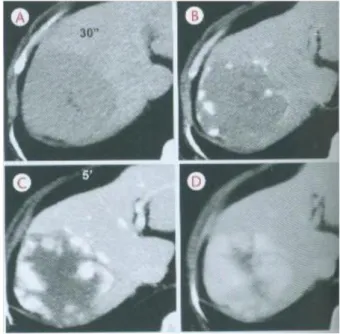 Figura 2 - Imagens de TC localizadas em região hepática demonstrando hemangioma e padrão típico de impregnação ao  meio de contraste