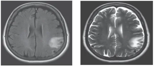 Figura 2. Ressonância magnética axial FLAIR e axial ponderada em T2, respectivamente, realizada em 2010, constatando  múltiplas lesões nodulares de hipossinal localizadas nas regiões parietais bilaterais, uma à esquerda com halo de 