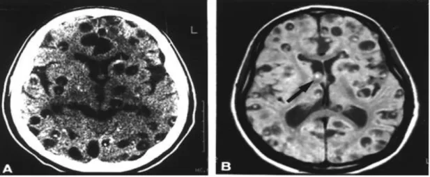 Figura 4 – A: Corte tomográfico do crânio, sem contraste endovenoso, mostrando múltiplas lesões císticas e calcificadas  pelo parênquima
