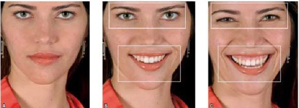 Figura 8 - Diferenças entre o sorriso social e o o sorriso de Duchenne: Posição de repouso (A), Sorriso  social (B), Sorriso de Duchenne (C) (Adaptada de De Saint Front, 2014) 