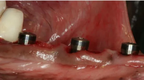 Figure 2.17. Lateral view of titanium implants placed in the extraction sockets. 