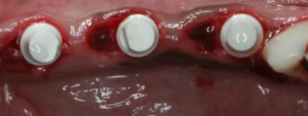 Figure 2.21. Occlusal view of zirconia implants placed in extraction sockets. 