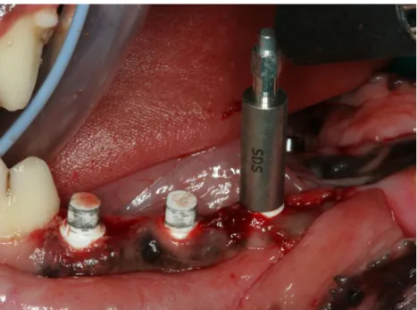 Figure 2.25. Primary stability evaluation using the Ostell ®  on zirconia implants. 