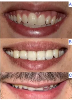Figura 9. Linha do sorriso alta (a), media (b) baixa (c). 